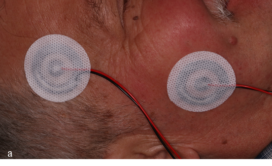 A person with electrodes on his face

Description automatically generated